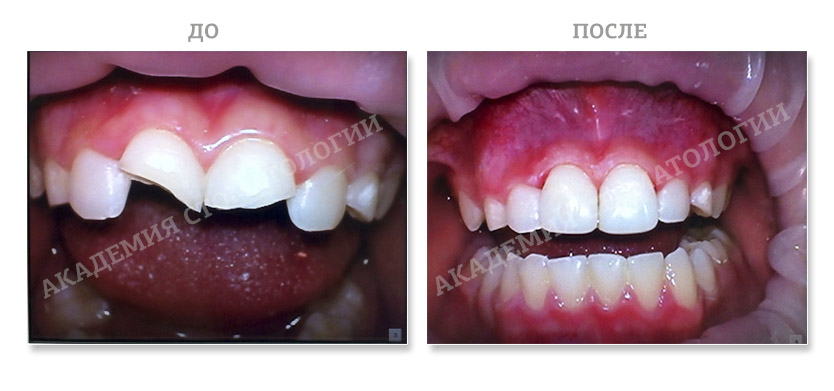 реставрация передних зубов, Академия стоматологии Набережные Челны