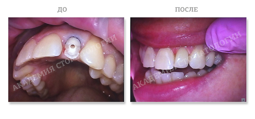 эстетическая реставрация 22 зуба, Академия стоматологии Набережные Челны