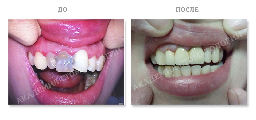 Реставрация зубов, Академия стоматологии Набережные Челны